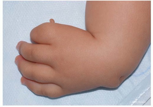 Radial Longitudinal Deficiency (Radial Club Hand)